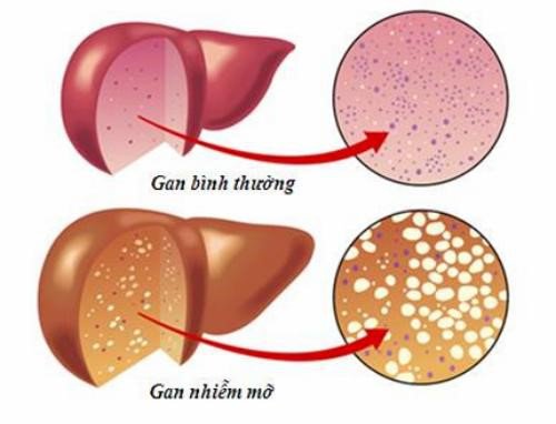 hình minh họa gan nhiễm mỡ