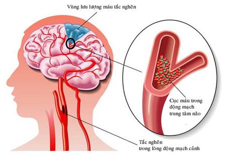 bệnh đột quy